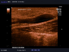 Ultrazvok kolena - bakerjeva cista